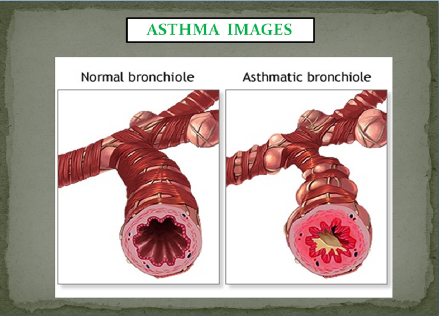 ASTHMA PACKAGES