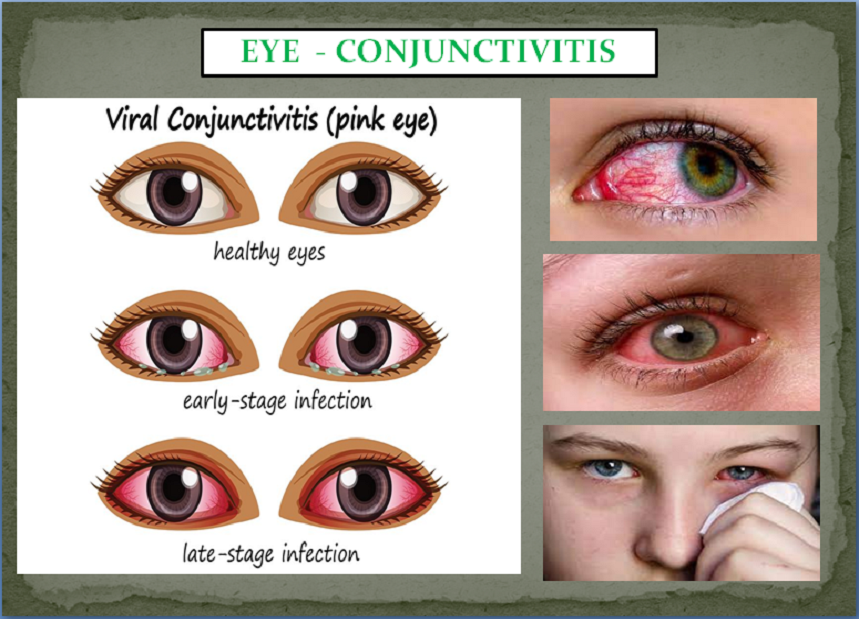 EYE PROBLEMS PACKAGE