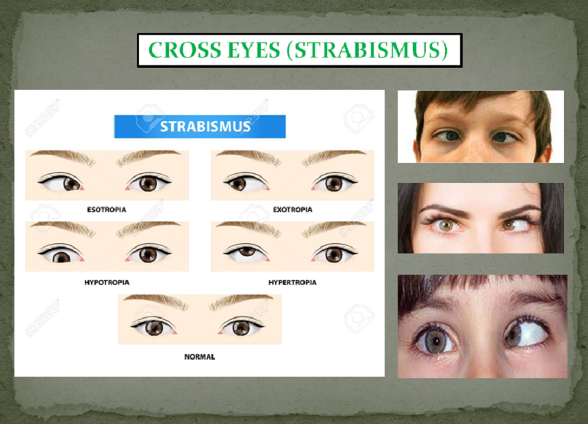 EYE PROBLEMS PACKAGE
