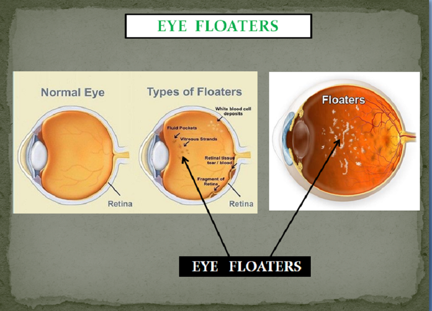 EYE PROBLEMS PACKAGE
