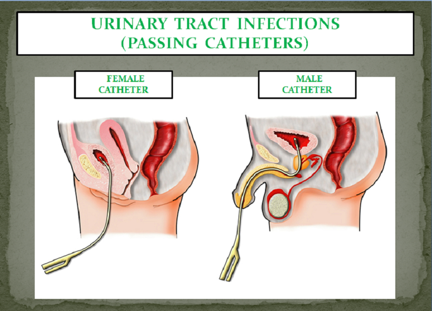 URINARY TRACT INFECTIONS